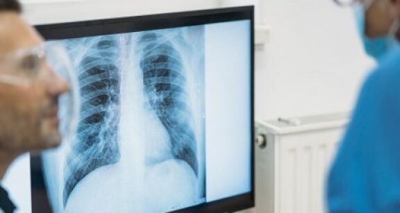 Vers un d&eacute;pistage organis&eacute; du cancer du poumon ?